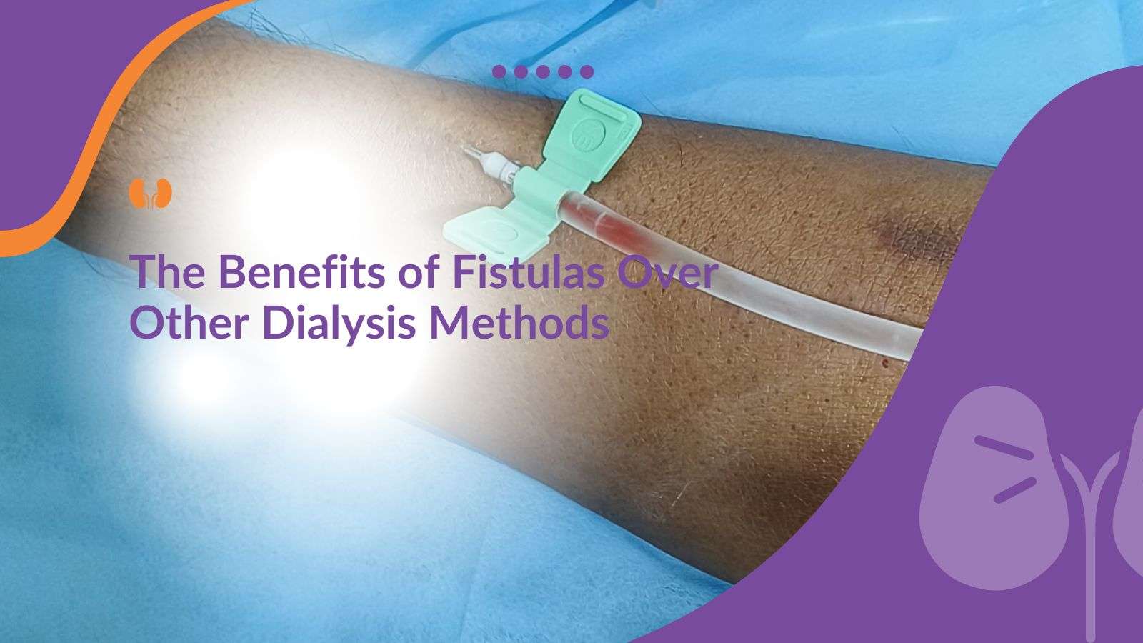 The Benefits of AV Fistulas Over Other Dialysis Methods